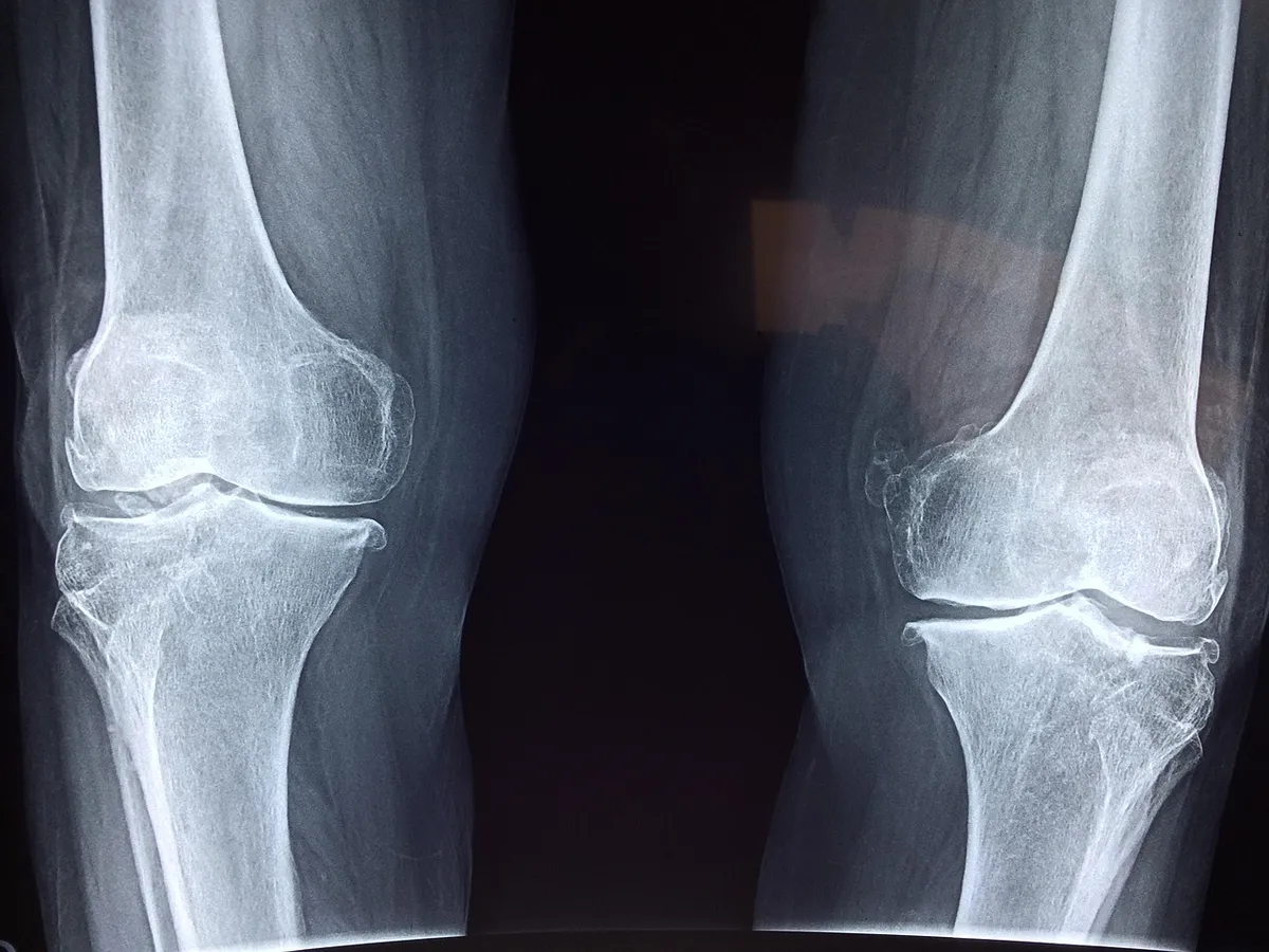 knee, x-ray, medical, anatomy, skeleton, bone, orthopedic, joint, health, injury, patient, cartilage, treatment, hospital, therapist, illness, disease, blue hea